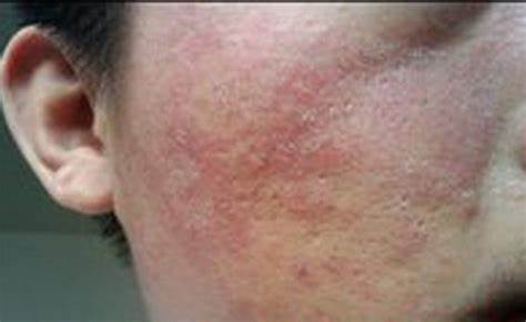 skin-allergy-3.jpg